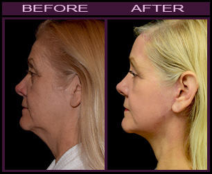 LazerLift™ Treatment Before And After