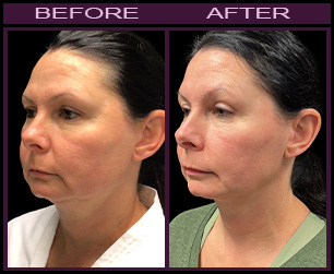 Before And After Lazerlift™ Treatment