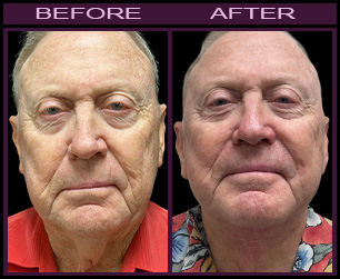 Laser Neck Lift Results