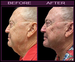 Laser Neck Lift Before And After