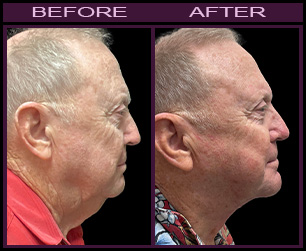 Laser Neck Lift Before & After