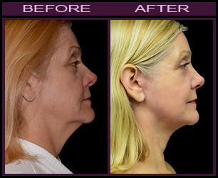 LazerLift™ Treatment Before & After