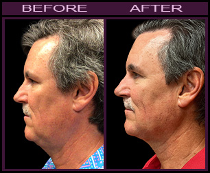 LazerLift™ Necklift Results