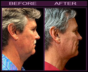 Lazerlift™ Necklift Before And After