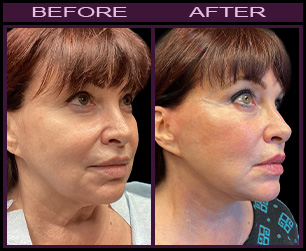 Laser Facelift Results