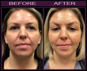 Laser Facelift Before & After