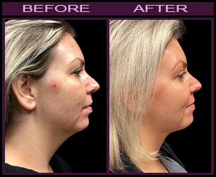 Laser Facelift Results, Side View