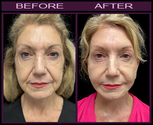 Results of LazerLift Treatment