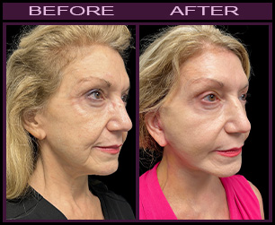 Results of LazerLift™ Treatment