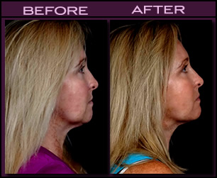 Before and After Laser Facelift 