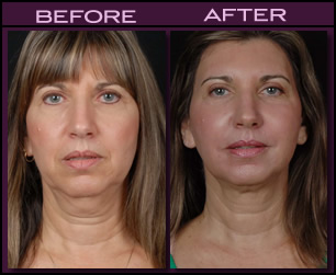 Laser Facelift Results