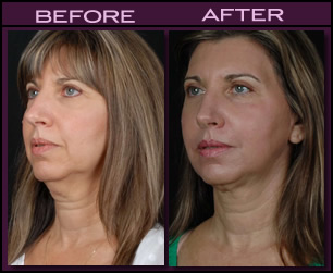 Before and After Laser Neck Lift