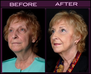 Orlando Facelift Results