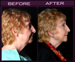 Laser Face Lift Before and After