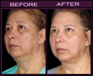 Laser Neck Lift Before and After