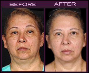 Laser Facial Rejuvenation Results