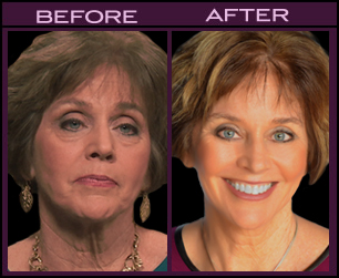 Facelift Results