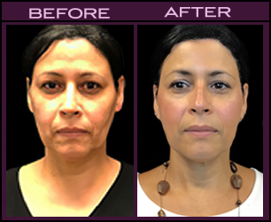 Laser Facial Rejuvenation Results