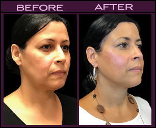 Results of Laser Facial Rejuvenation