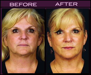 Facelift Before and After