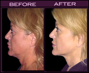 Facelift Results